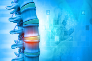 Critical Factors That Affect a Spinal Cord Injury Claim