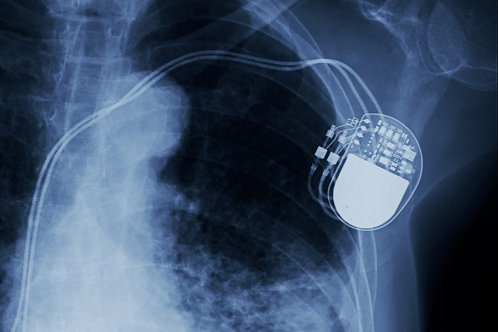 pacemaker