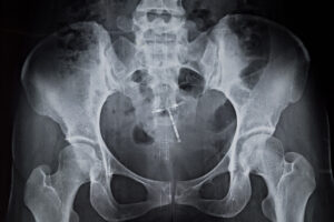 pelvis x-ray